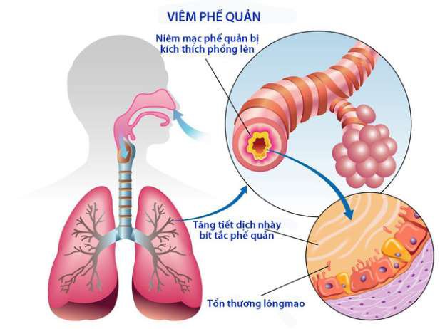 Khi các tác nhân gây hại xâm nhập vào phổi, phế quản sẽ làm cho đường hô hấp bị viêm, nhiễm trùng