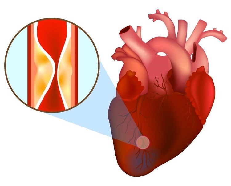 Đau thắt ngực – dấu hiệu điển hình nhất của nhồi máu cơ tim.