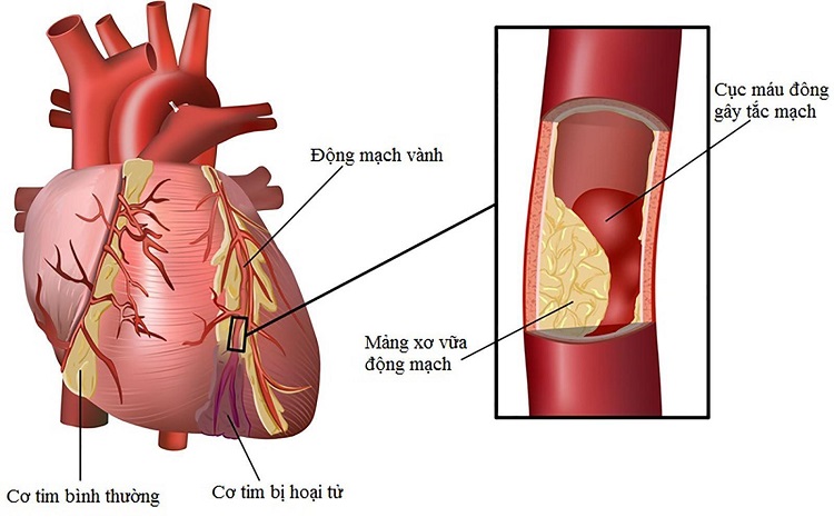 bệnh thiếu máu cơ tim